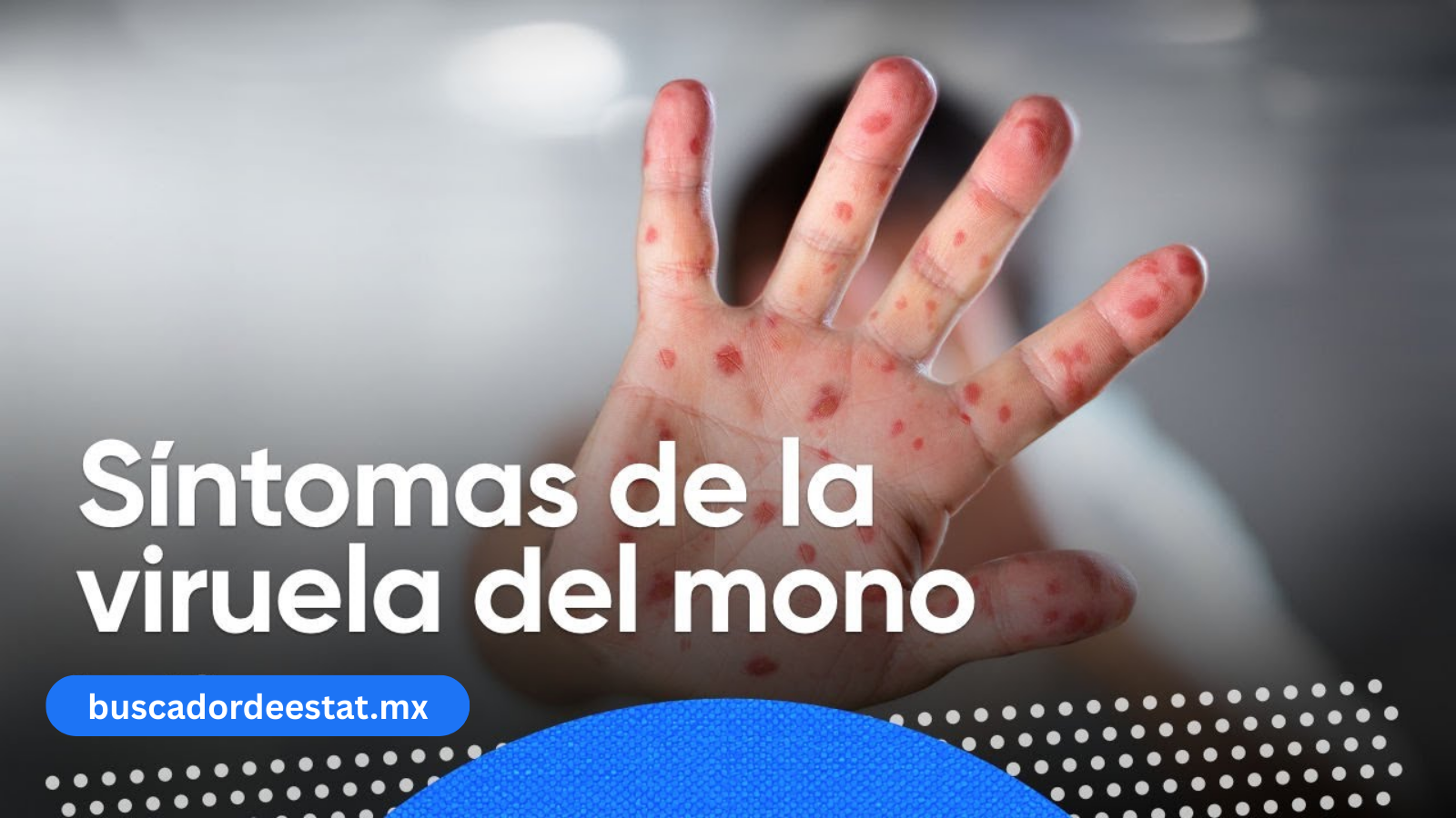 Salud y alertas: viruela del mono y aviso de huracán categoría I en México